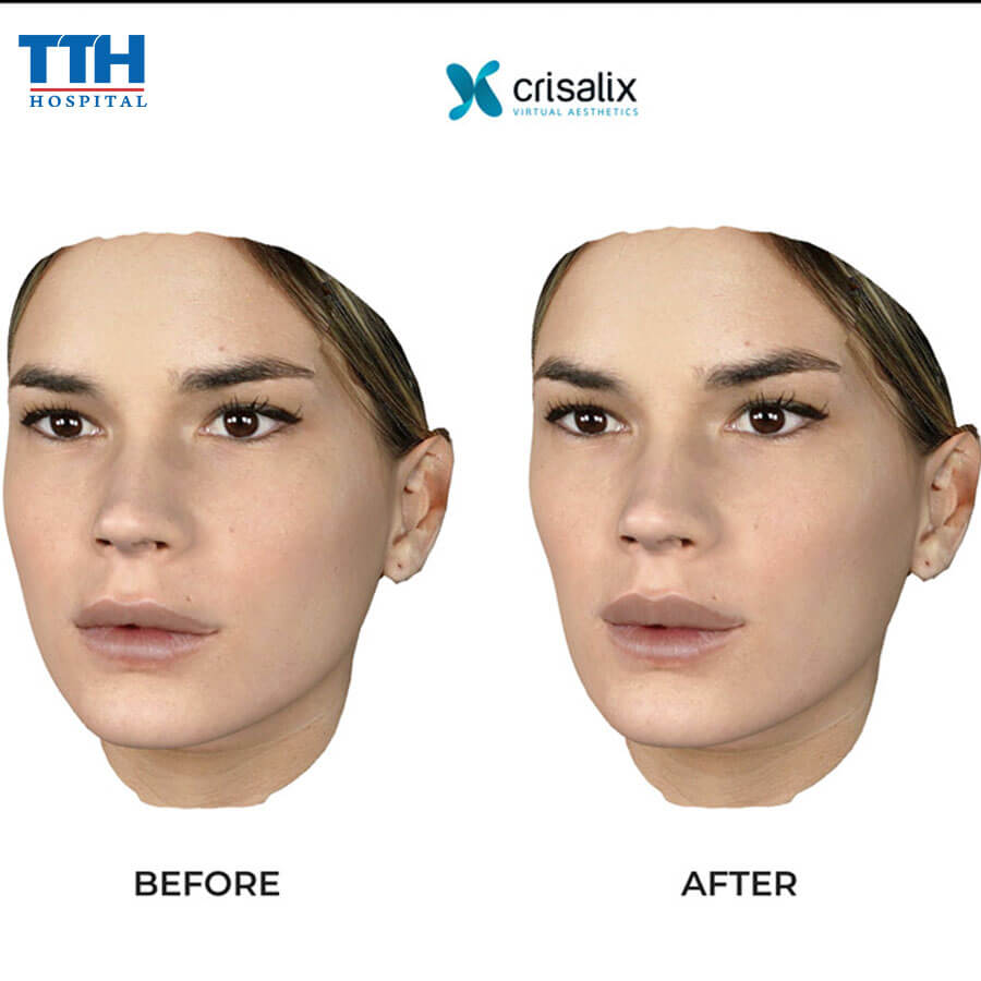 Áp dụng công nghệ mô phỏng 3D Crisalix vào phẫu thuật cắt mí tại bệnh viện Thái Thượng Hoàng