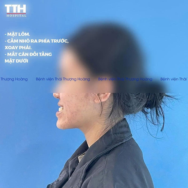 BỆNH VIỆN THÁI THƯỢNG HOÀNG TIẾP TỤC THỰC HIỆN THÀNH CÔNG PHẪU THUẬT CHỈNH XƯƠNG HAI HÀM 