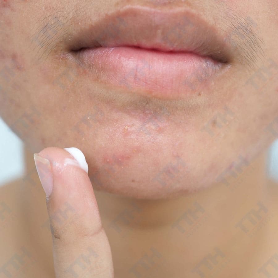 Các bước xử lý mụn viêm, mụn ẩn trước Tết 2025