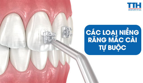 Các Loại Niềng Răng Mắc Cài Tự Buộc
