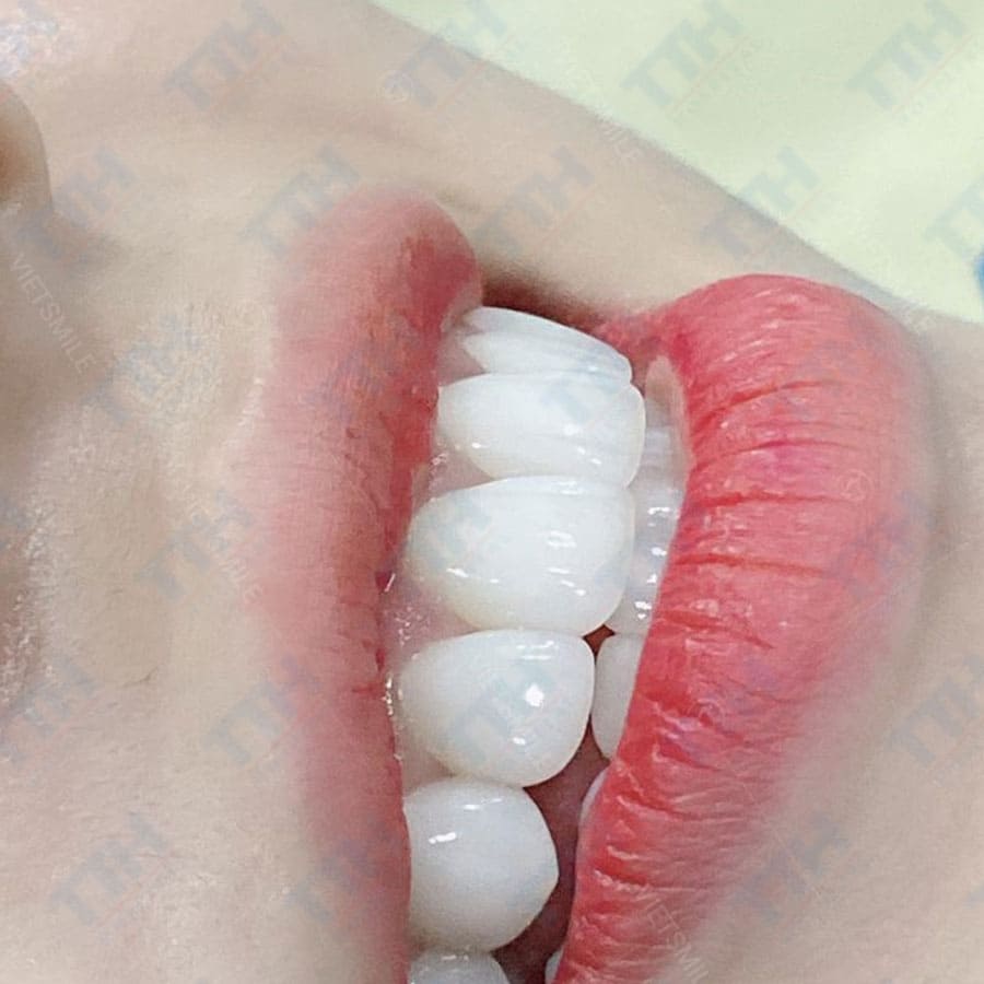 Các loại răng sứ Orodent hiện nay