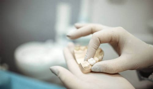 Các loại răng sứ Orodent hiện nay