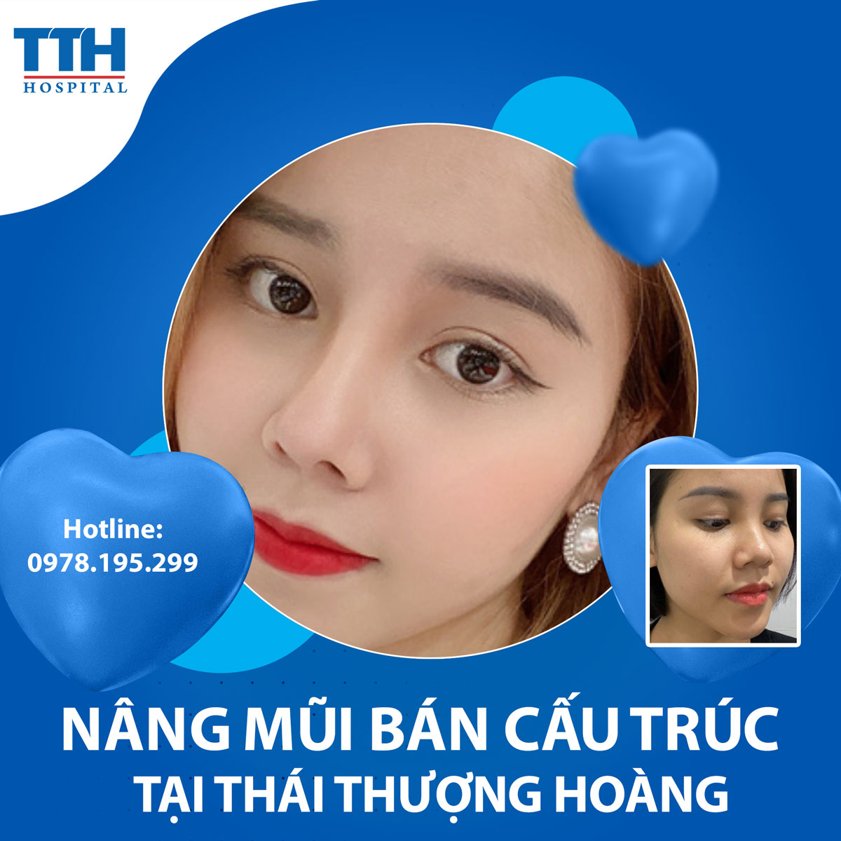Các phương pháp nâng mũi hiện nay