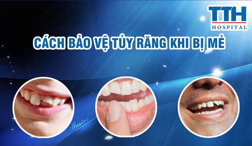 Cách bảo vệ tủy răng khi răng bị mẻ