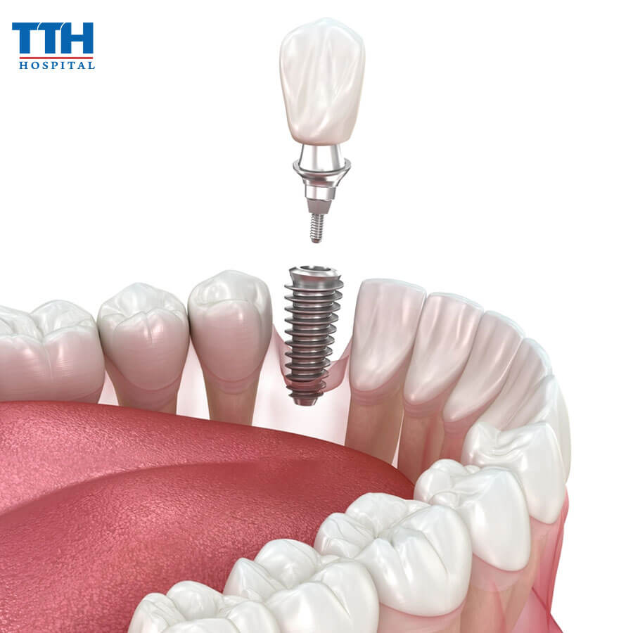 Cách Xử Lý Khi Trồng Răng Implant Bị Lung Lay