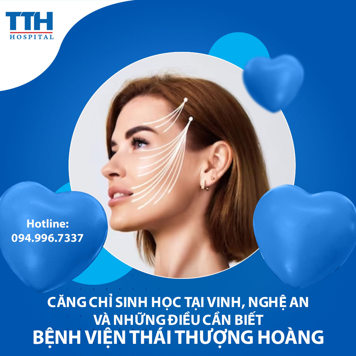 Căng chỉ sinh học tại Vinh, Nghệ An và những điều cần biết