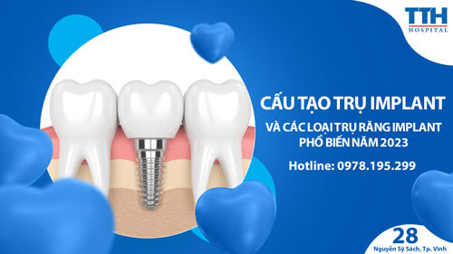 Cấu tạo Trụ Implant và Các Loại Trụ Implant Phổ Biến Năm 2023