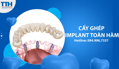 Cấy ghép Implant toàn hàm