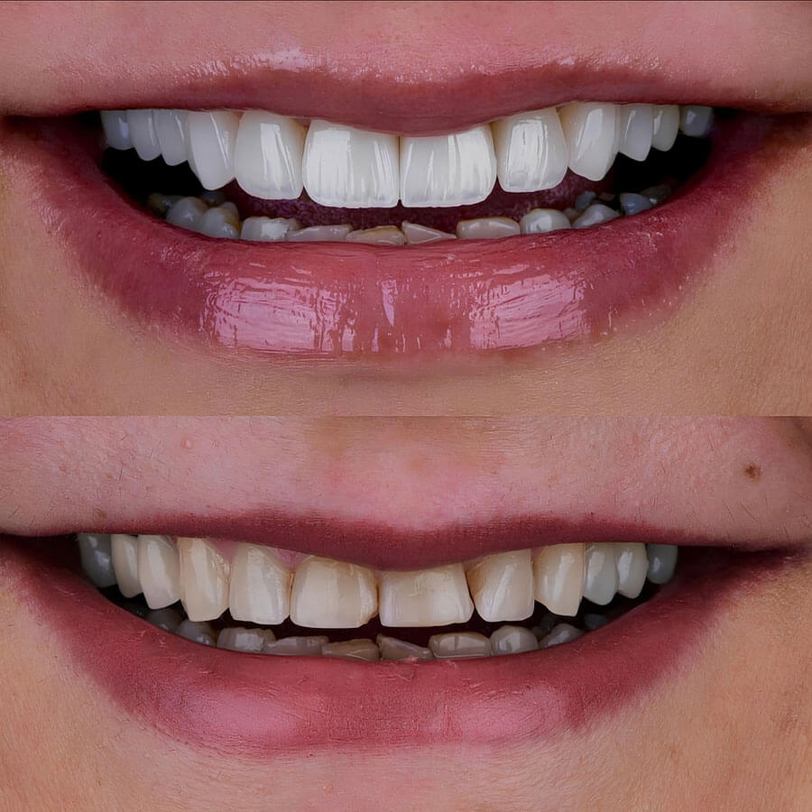 Chăm Sóc Răng Sứ Zirconia: Bí Quyết Duy Trì Độ Bền và Đẹp