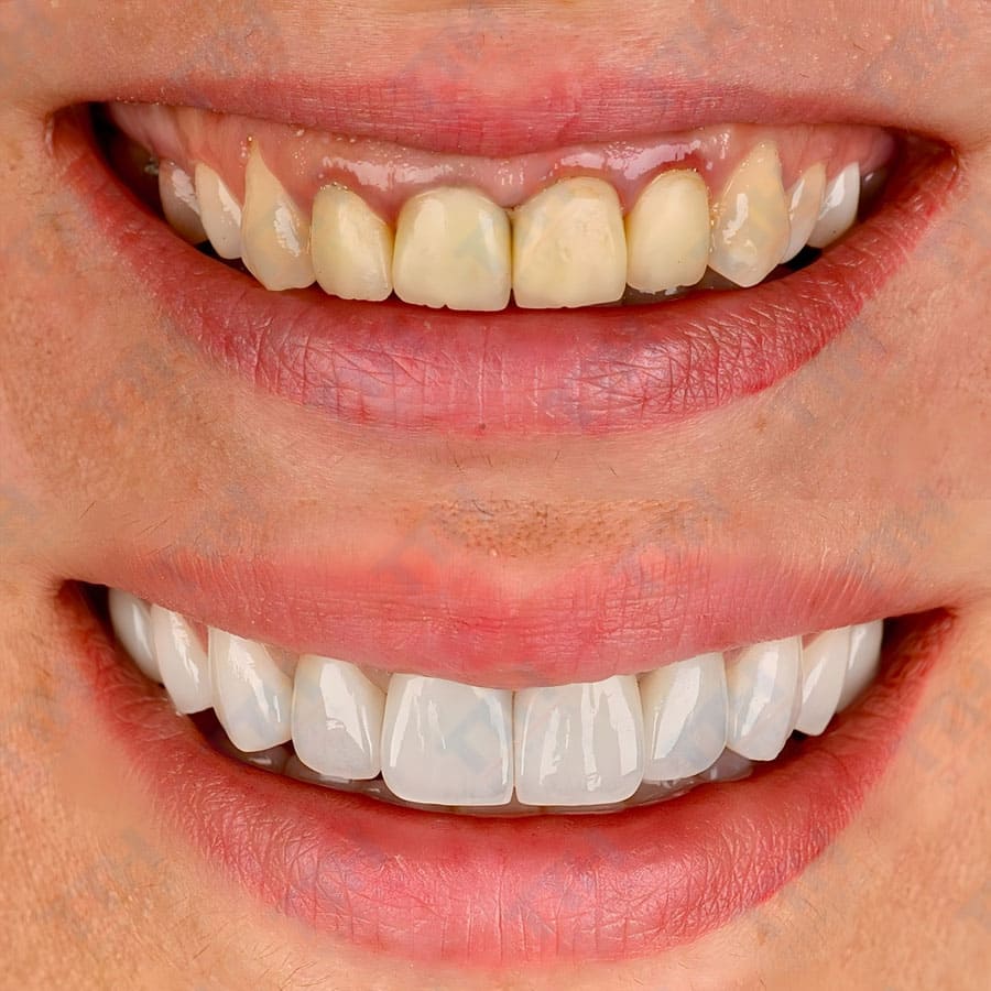 Chi Phí Bọc Răng Sứ Cho Việt Kiều Về Nước Dịp Tết