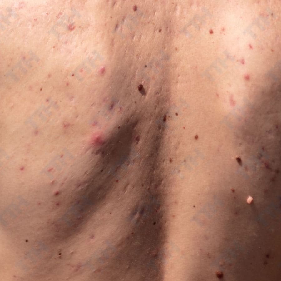 Có nên nặn mụn lưng không? Những điều cần biết