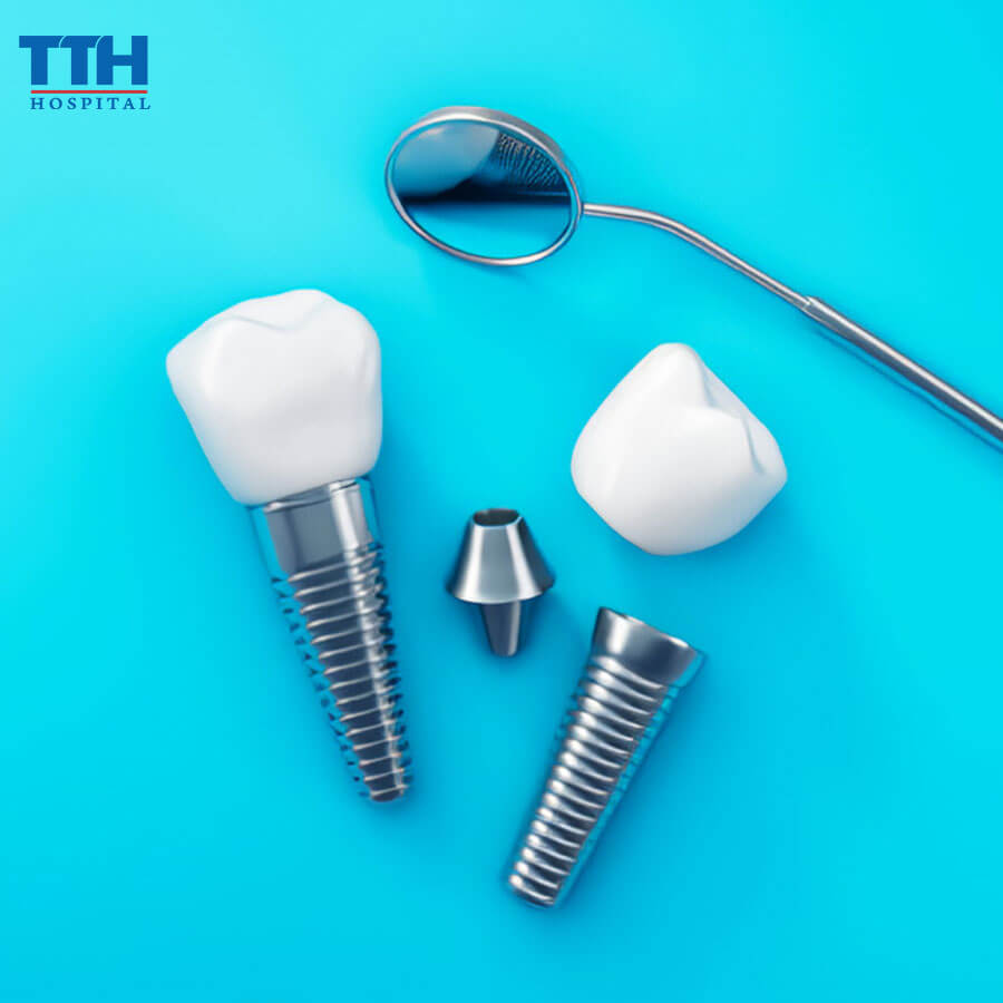 Công Nghệ Trồng Răng Implant Hiện Đại Tại Bệnh Viện Thái Thượng Hoàng