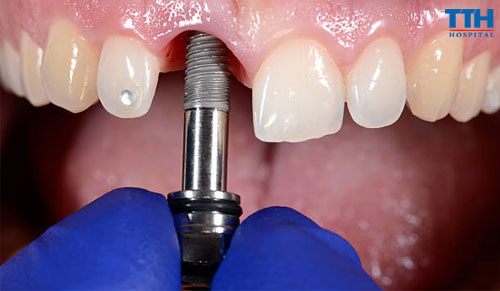 Công Nghệ Trồng Răng Implant Hiện Đại Tại Bệnh Viện Thái Thượng Hoàng