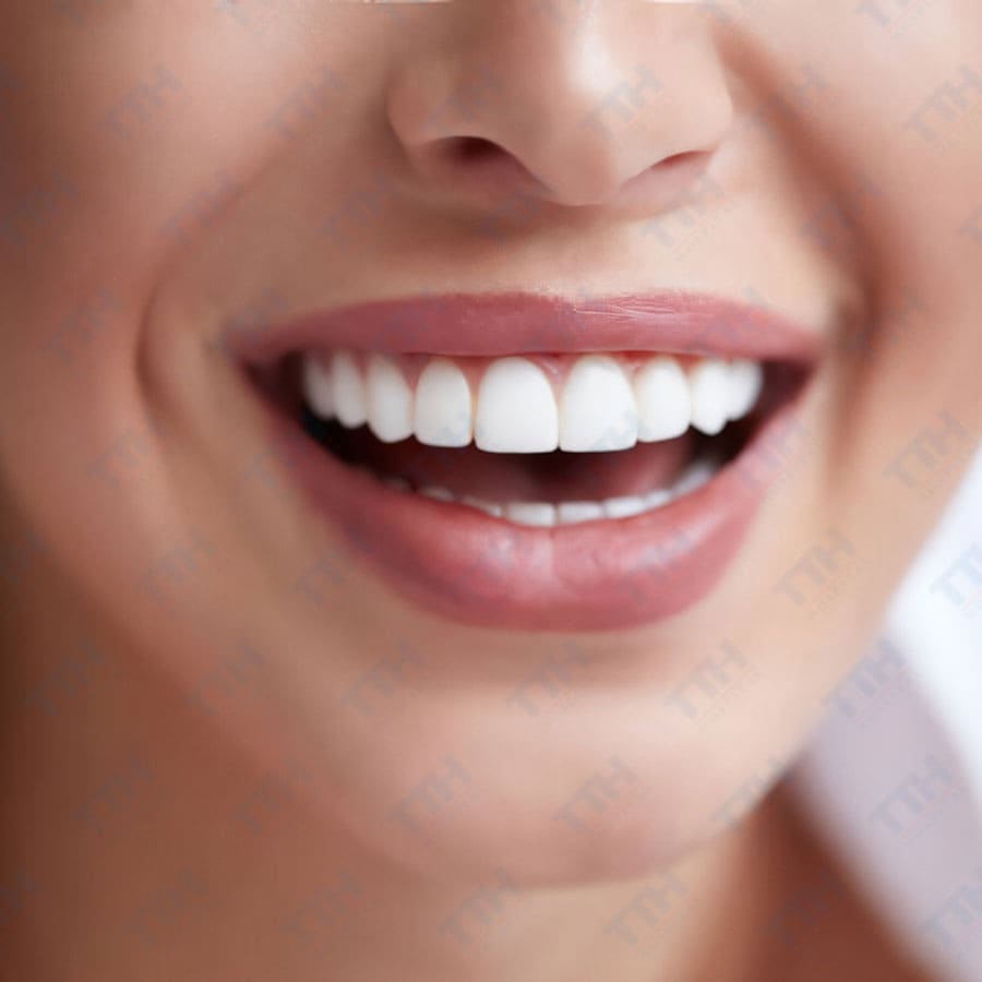 Dán Răng sứ Diamond Veneer có bền không?