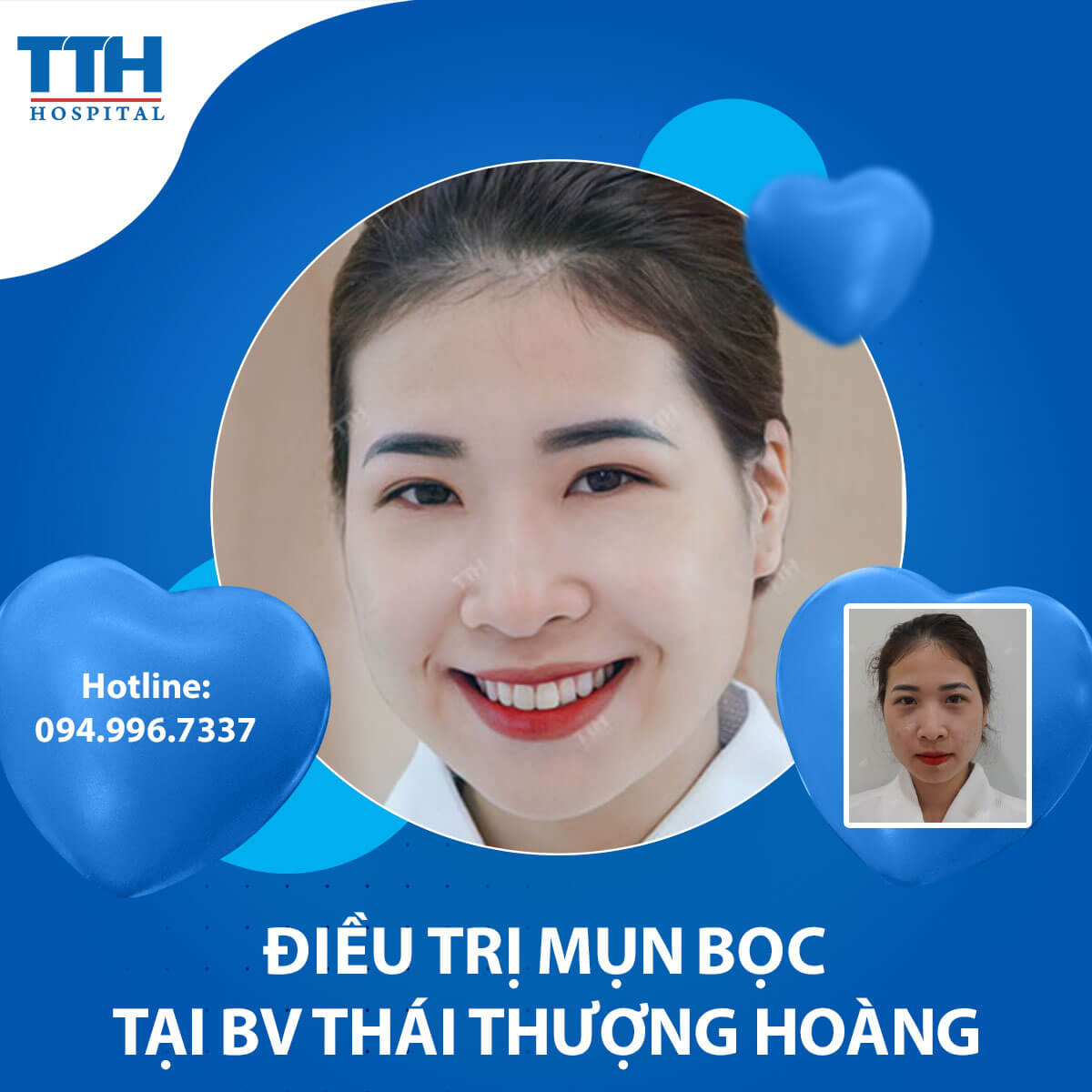 Điều trị mụn bọc và những điều cần biết
