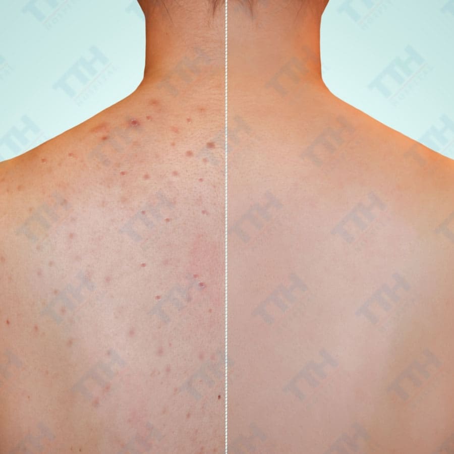 Điều trị mụn lưng bằng công nghệ ánh sáng sinh học IPL kết hợp Oxy Jet Aqua Peel