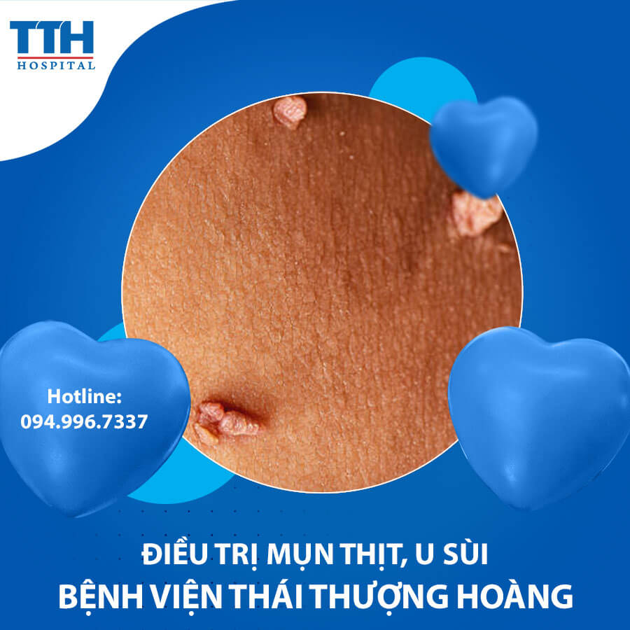 Điều trị mụn thịt, u sùi