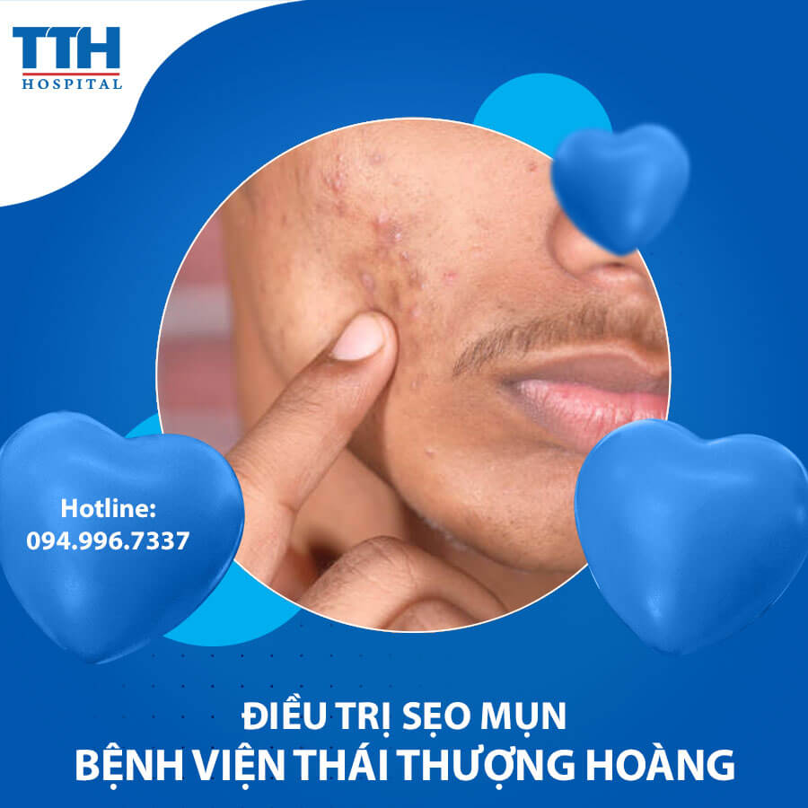 Điều trị sẹo mụn