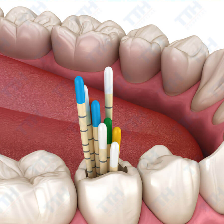 Điều trị tủy răng và hàn kín hệ thống ống tủy bằng gutta percha nguội