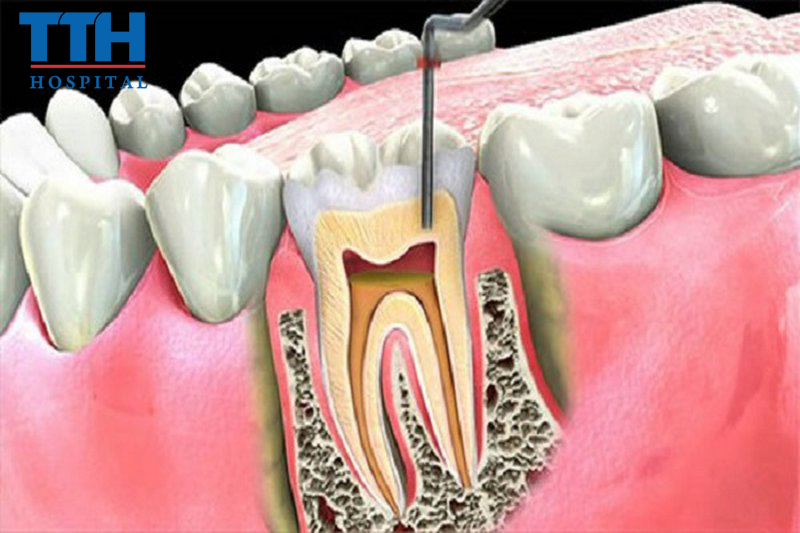 Điều trị tủy răng - Bệnh viện Thái Thượng Hoàng