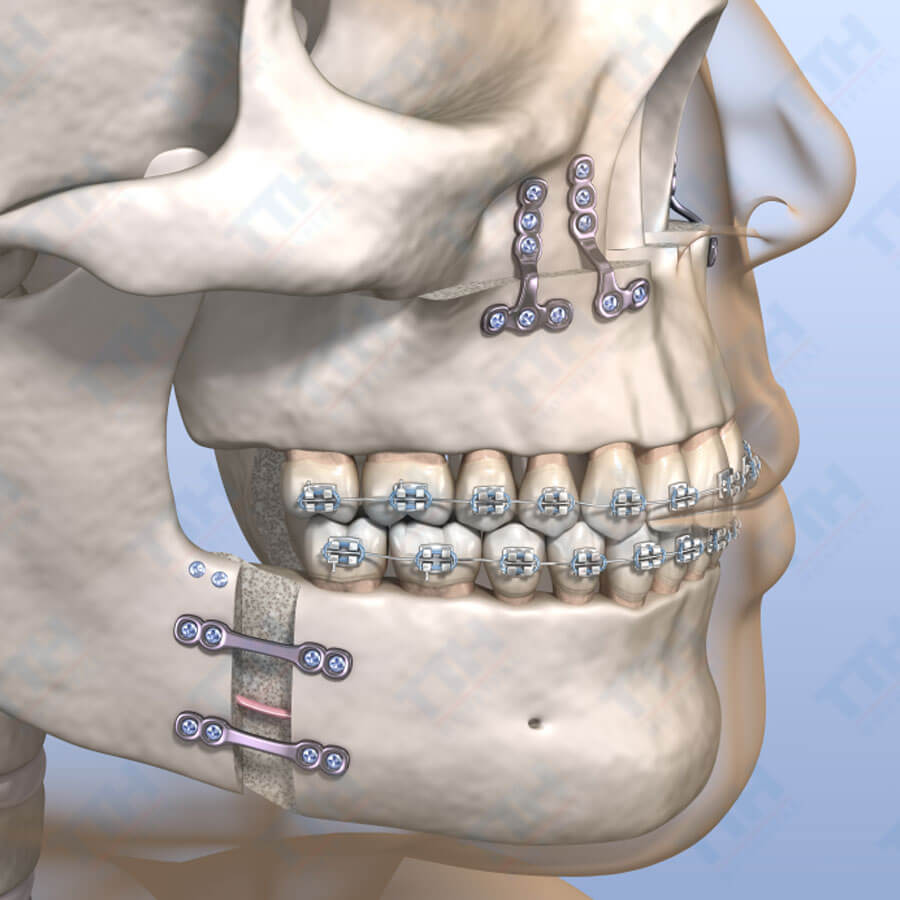 Độ tuổi vàng để thực hiện Phẫu Thuật Hàm Mặt