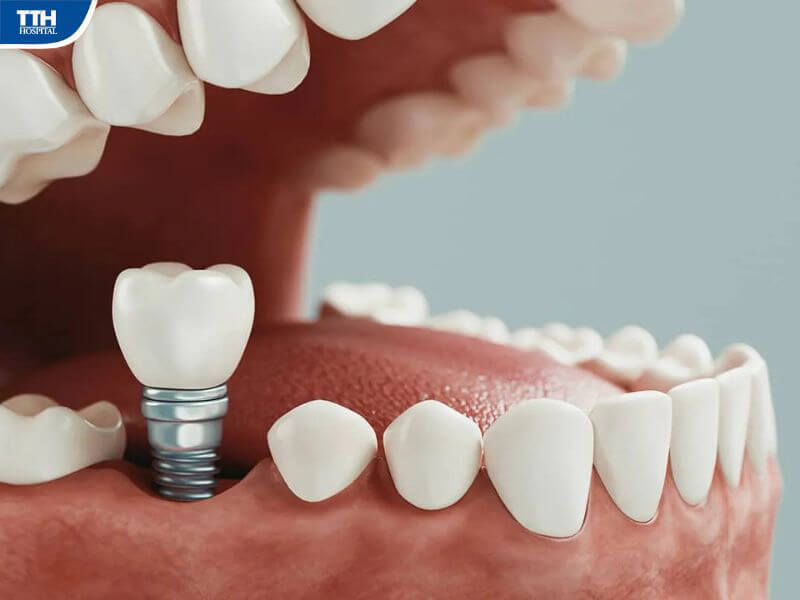 8 lợi ích khi trồng răng implant bạn nên biết