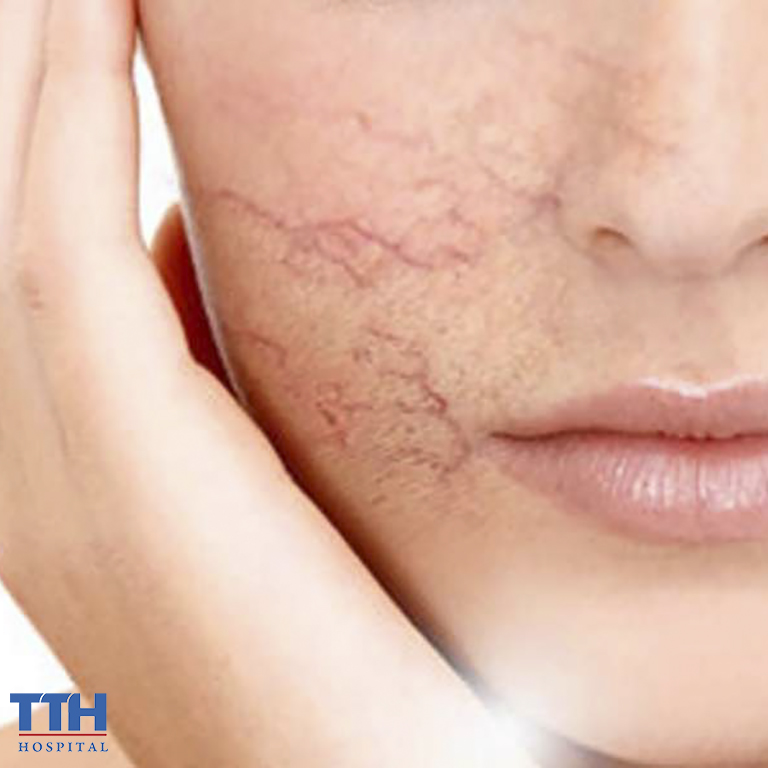 Điều trị giãn mao mạch công nghệ Q10 Prenium