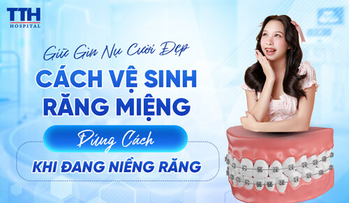 Giữ Gìn Nụ Cười Đẹp: Hướng Dẫn Vệ Sinh Răng Miệng Đúng Cách Khi Đang Niềng Răng