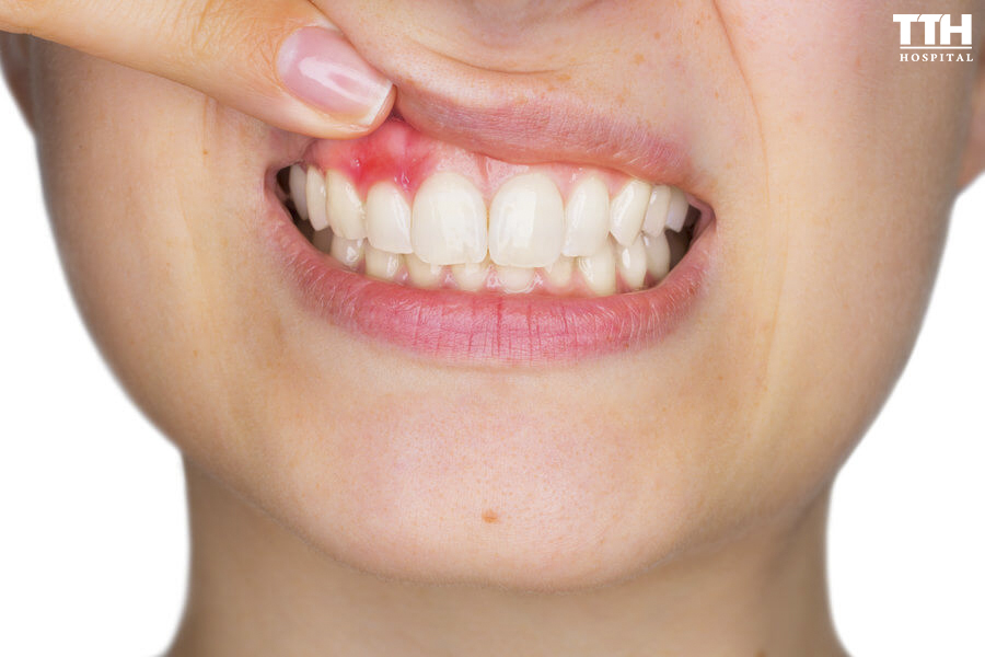 VIÊM NHA CHU - TRIỆU CHỨNG VÀ NGUYÊN NHÂN