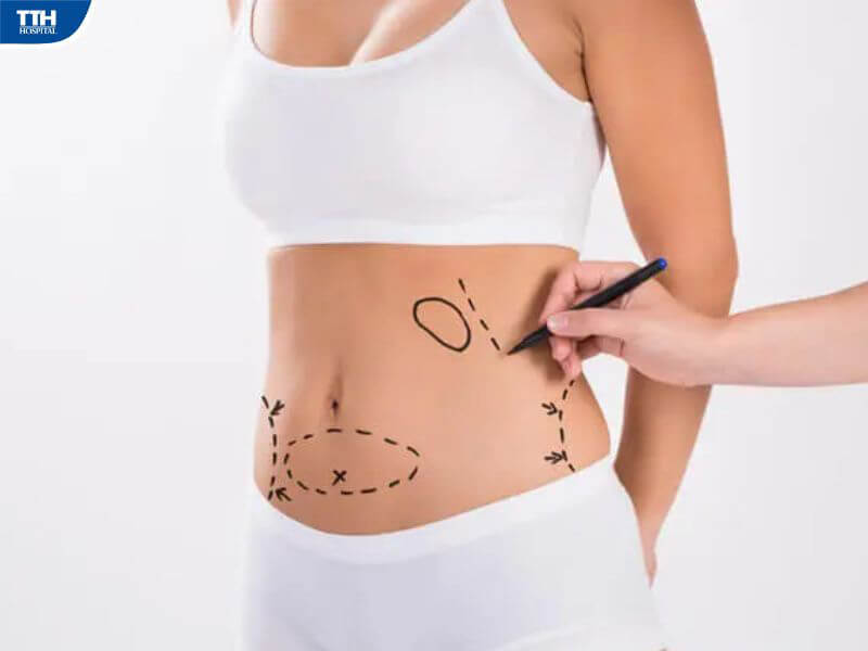 Hút mỡ an toàn – Nhẹ nhàng lấy lại vóc dáng thon gọn, tự tin khoe dáng xinh