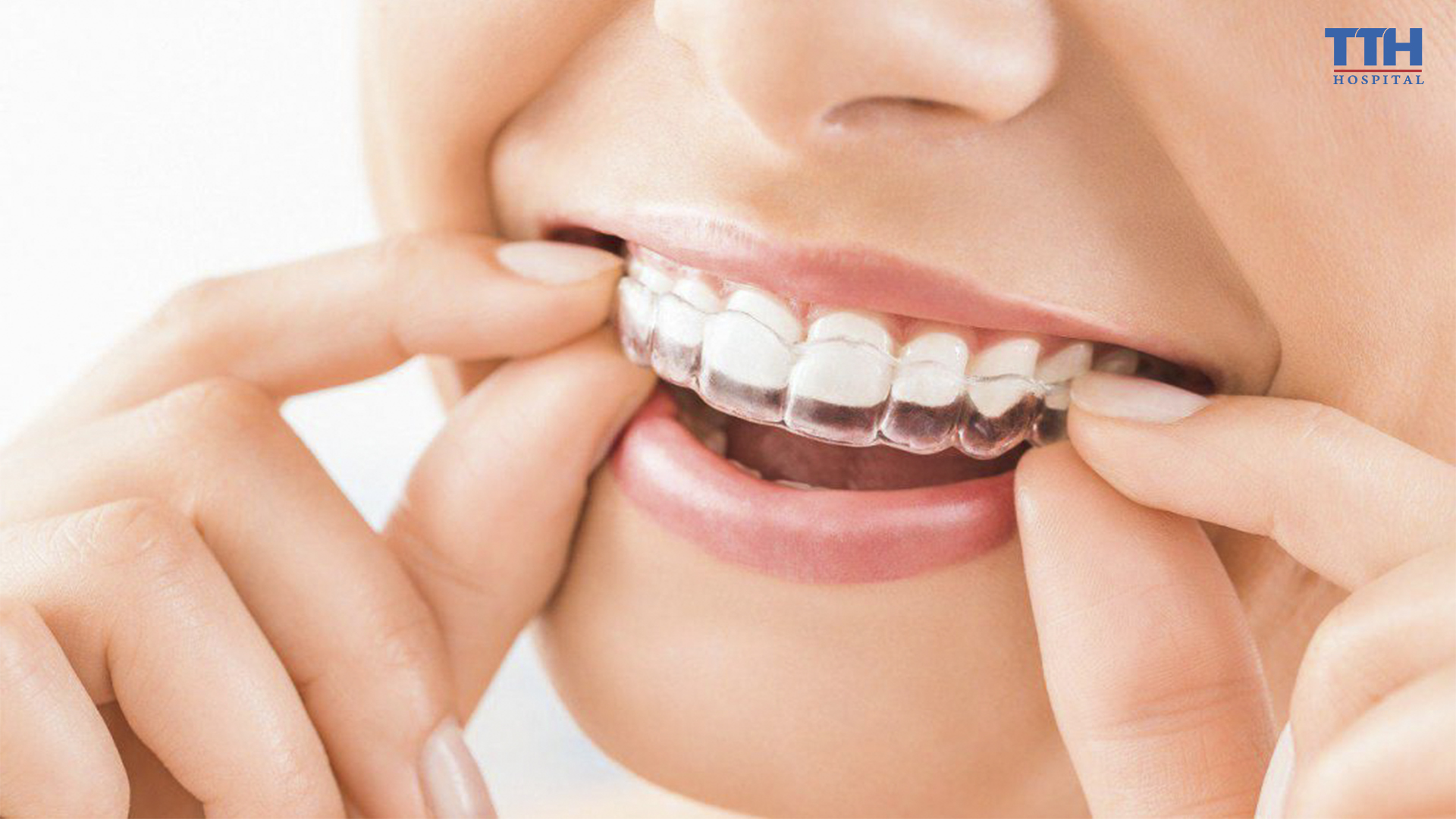 INVISALIGN - GIẢI PHÁP NIỀNG RĂNG TRONG SUỐT