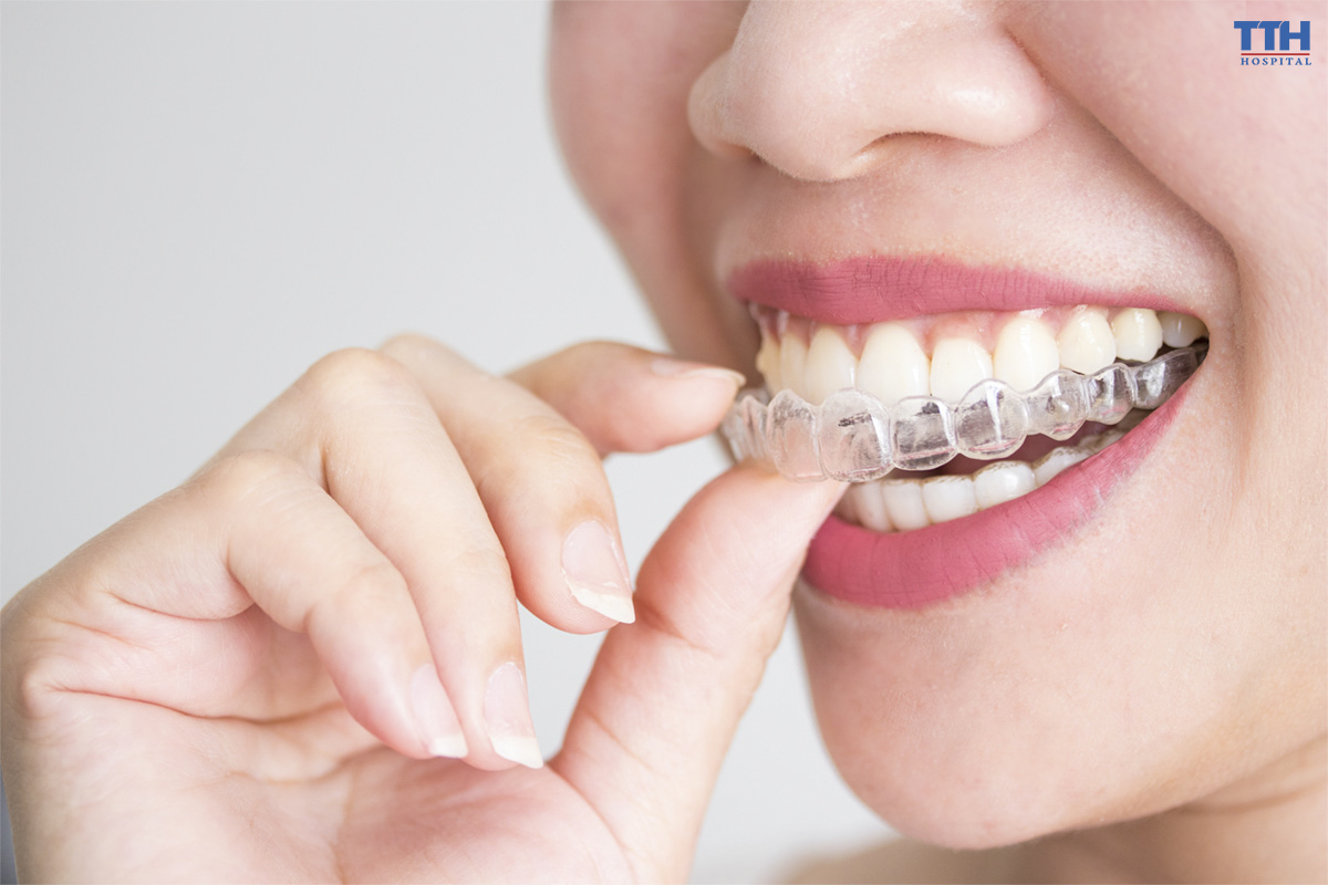 RÚT NGẮN THỜI GIAN NIỀNG RĂNG VỚI INVISALIGN