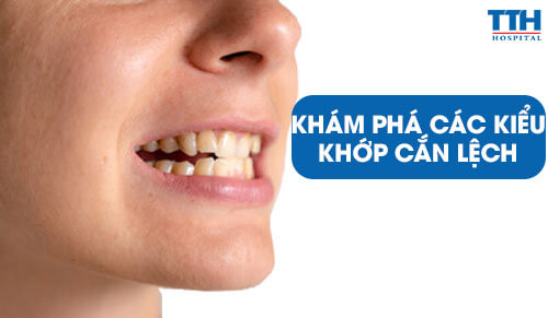 Khám Phá Các Kiểu Khớp Cắn Lệch