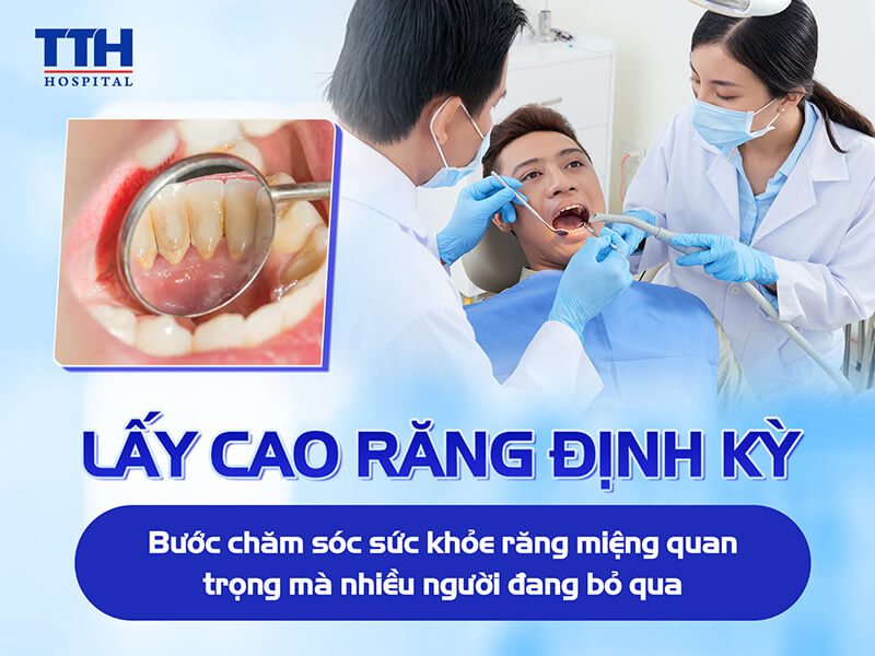 LẤY CAO RĂNG ĐỊNH KỲ