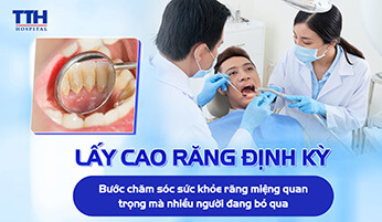 LẤY CAO RĂNG ĐỊNH KỲ