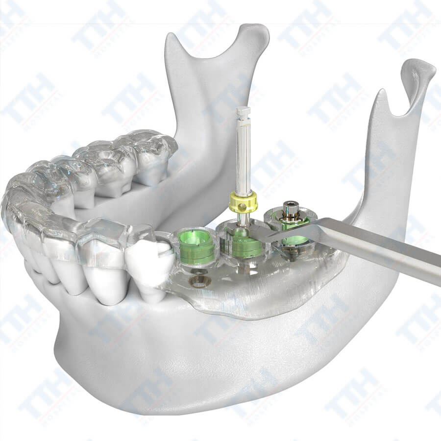 Lợi Ích Của Máng Hướng Dẫn Phẫu Thuật Implant