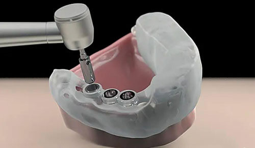 Lợi Ích Của Máng Hướng Dẫn Phẫu Thuật Implant