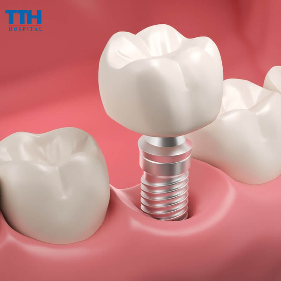 Lợi Ích Của Trồng Răng Implant So Với Các Phương Pháp Truyền Thống