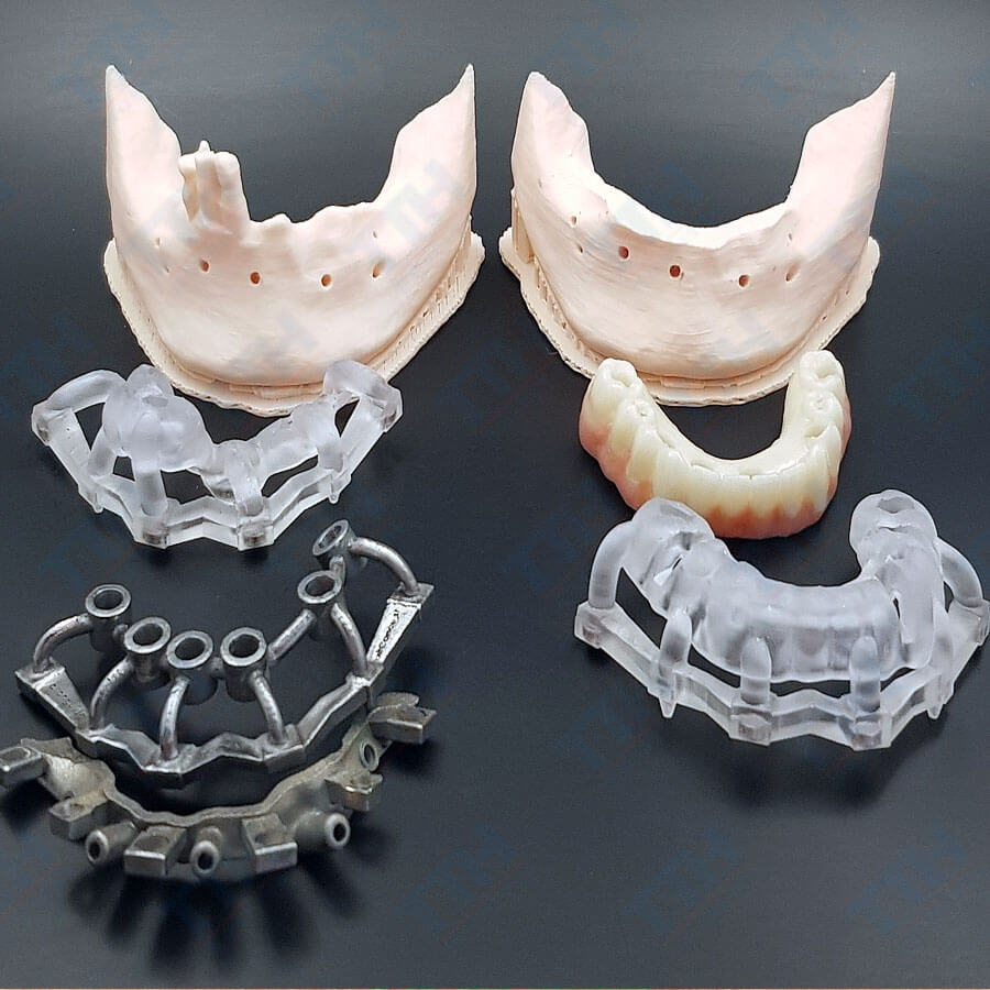 Máng hướng dẫn phẫu thuật implant là gì?