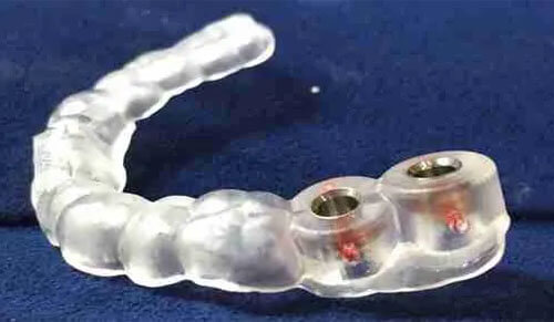 Máng hướng dẫn phẫu thuật implant là gì?