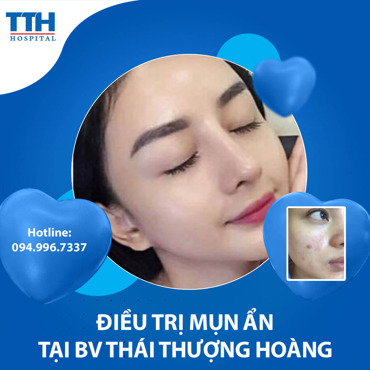 Mụn ẩn và những điều cần biết
