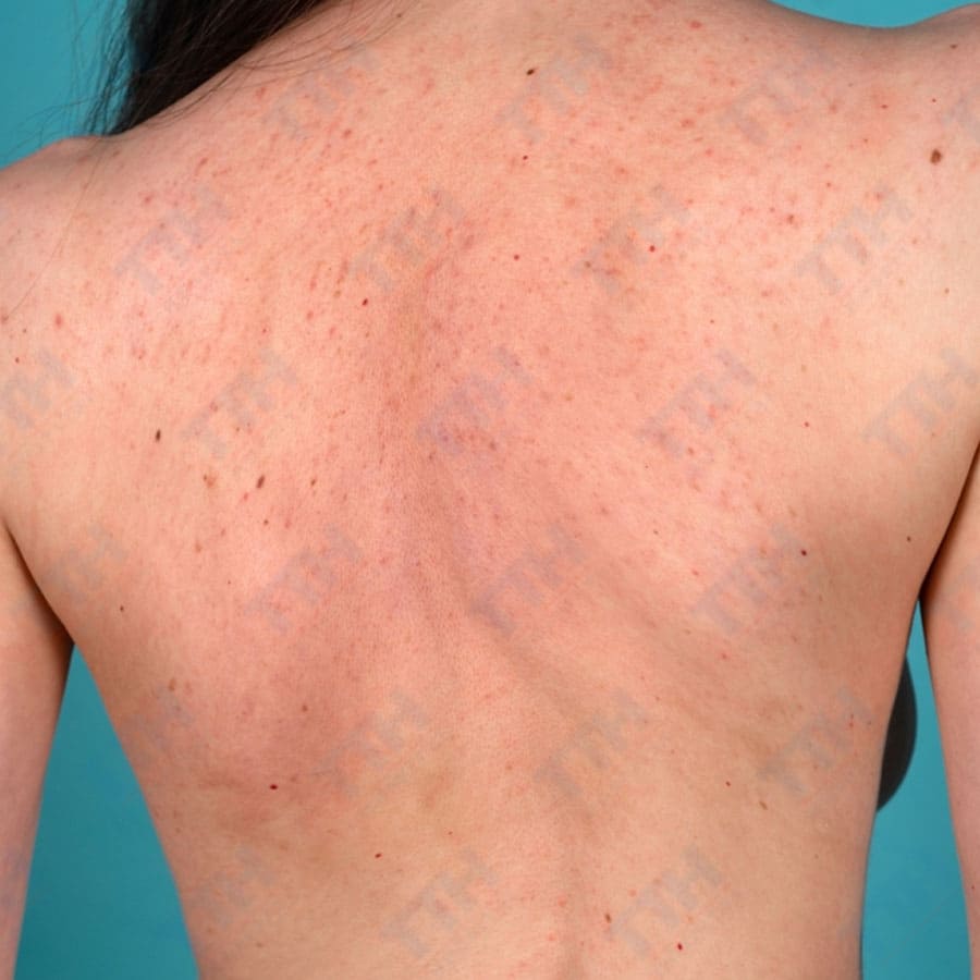 Mụn lưng dai dẳng: Nguyên nhân và giải pháp hiệu quả bạn nên biết