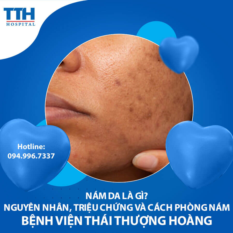 Nám da là gì? Nguyên nhân, triệu chứng và cách phòng nám