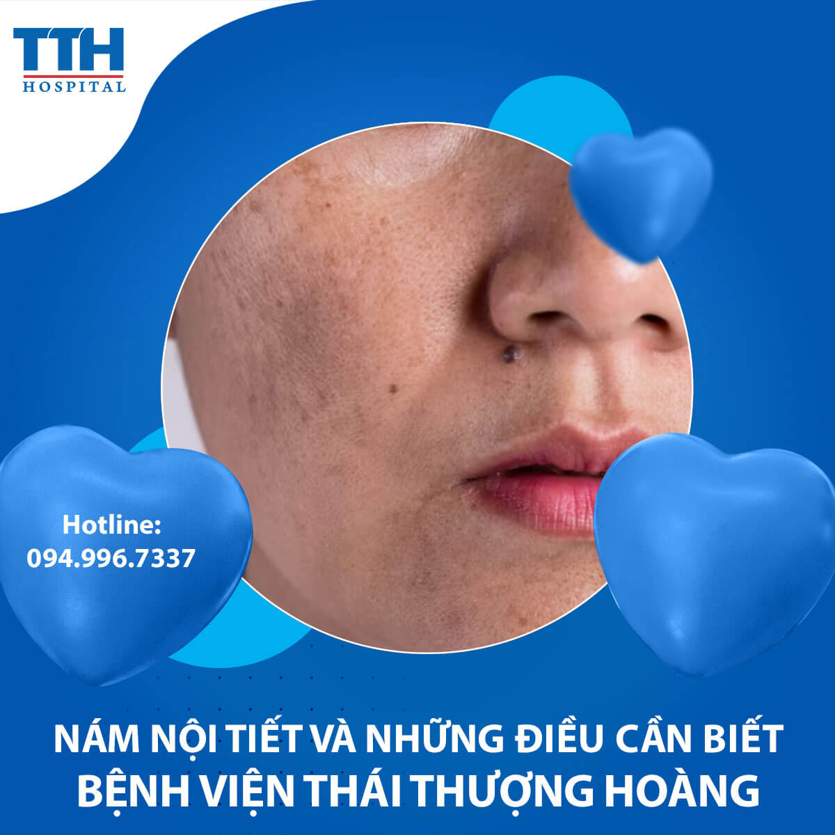 Nám Nội Tiết và Những Điều Cần Biết