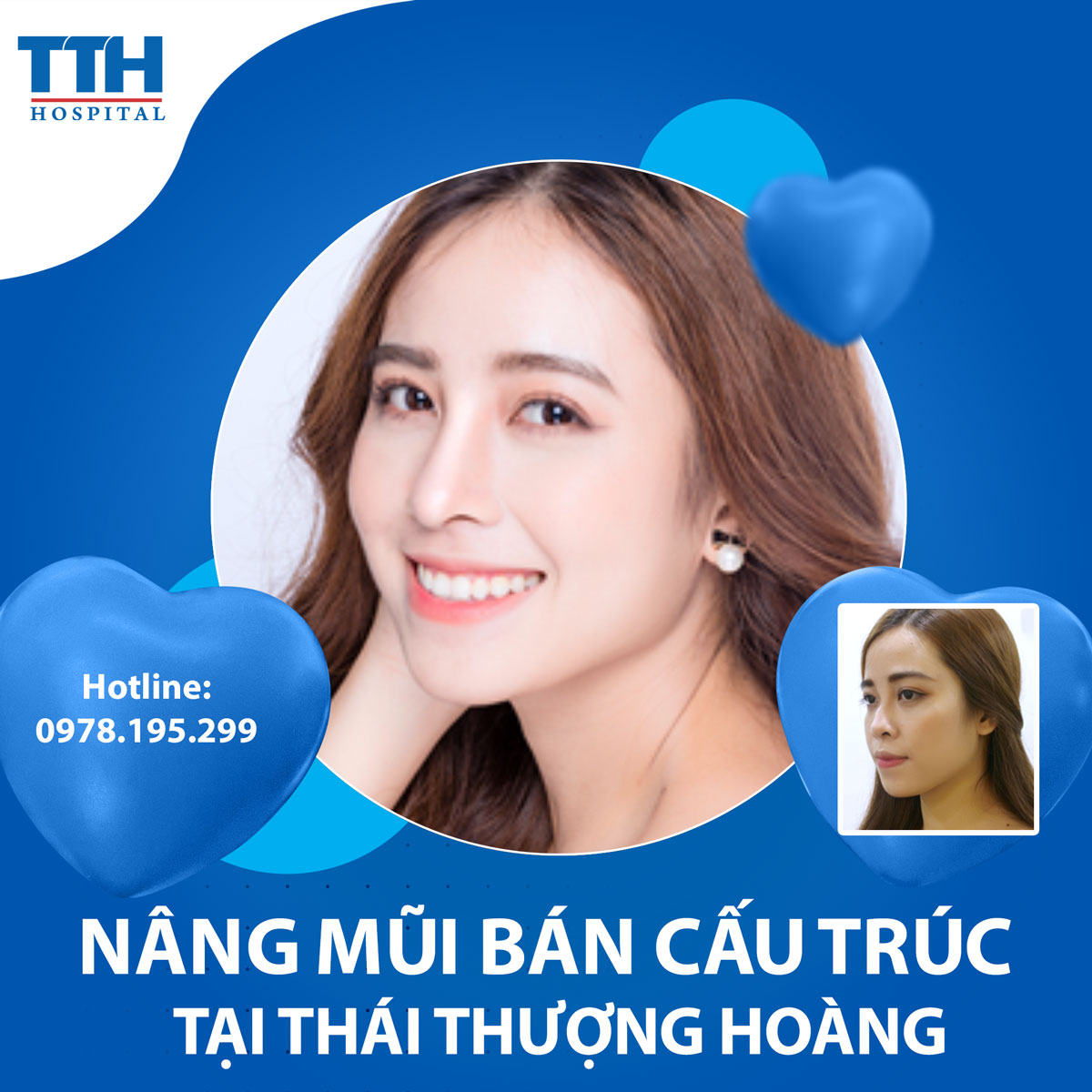 Nâng mũi bán cấu trúc - Tạo nét đẹp hoàn hảo cho gương mặt