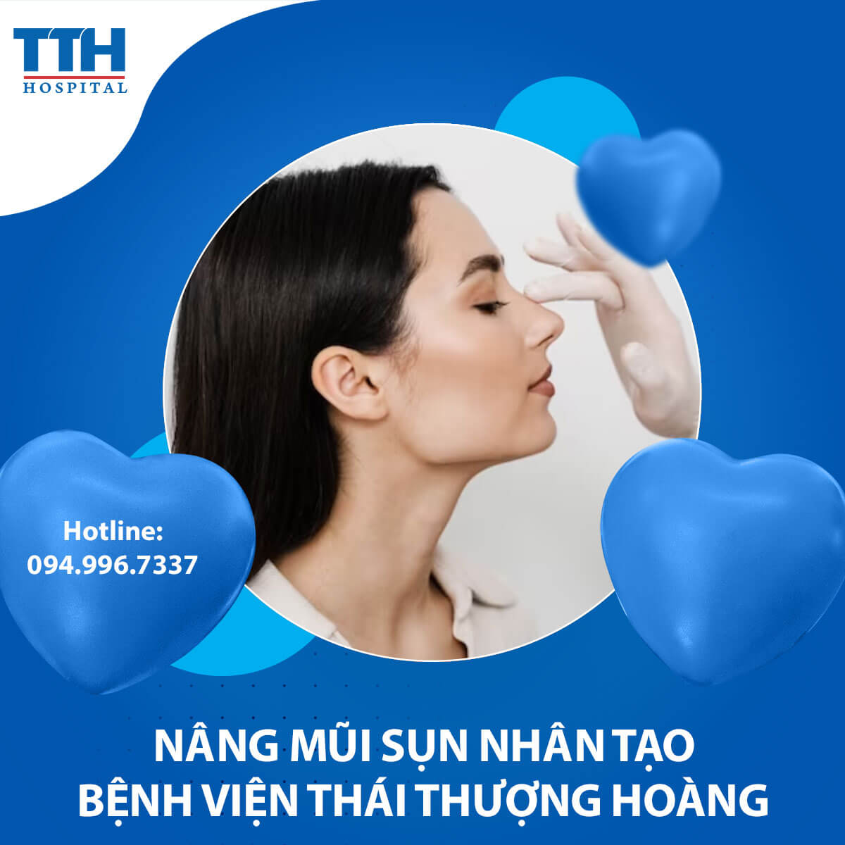 Nâng mũi sụn nhân tạo