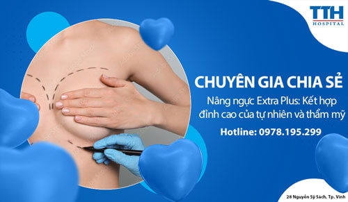 Nâng ngực Extra Plus: Kết hợp đỉnh cao của tự nhiên và thẩm mỹ