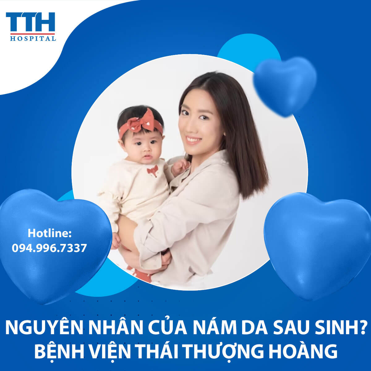Nguyên nhân của nám da sau sinh?