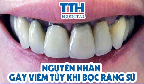 nguyên nhân gây viêm tủy khi bọc răng sứ
