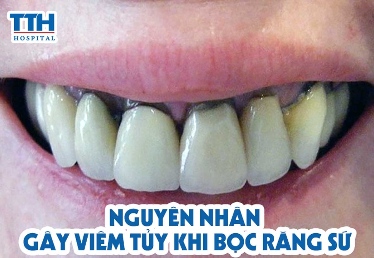 nguyên nhân gây viêm tủy khi bọc răng sứ